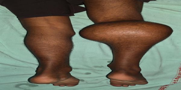 A FIRST: 2-kg tumor removed from leg bone, complex surgery successful at SRN Hospital