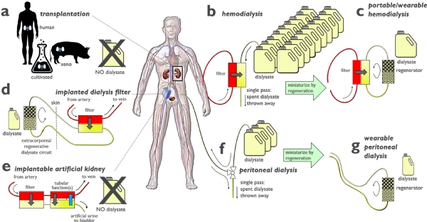 Kidney in Your Pocket-New Era Begins