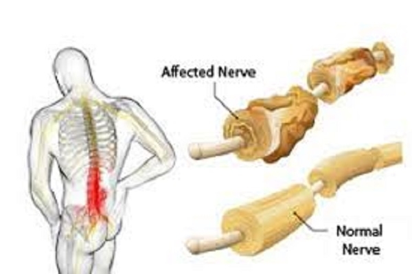 Outbreak of Guillain-Barre Syndrome(GBS)