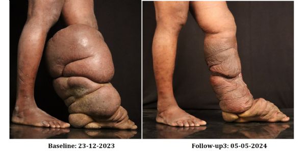 SCALING LIFE: IAD’s Integrated Medicine for Effective Treatment of Lymphatic Filariasis Morbidity and Disability in India