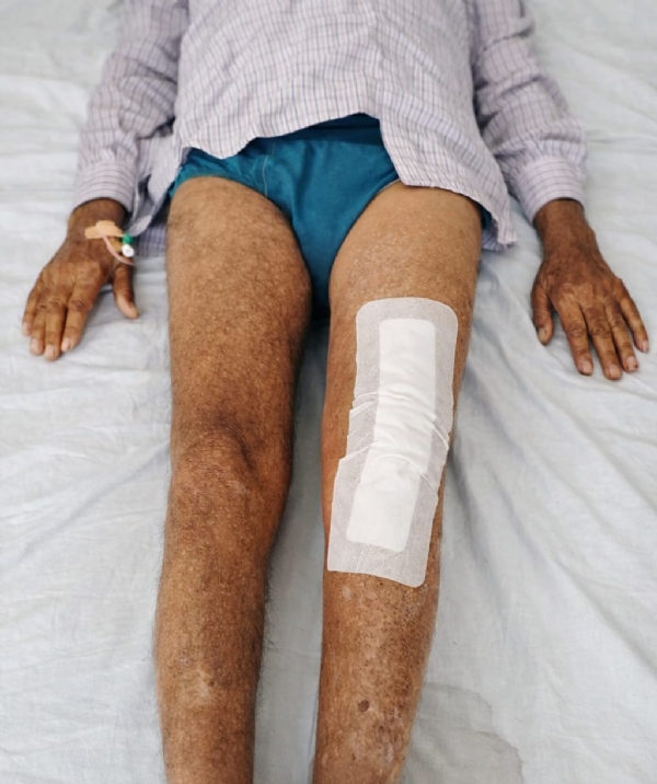 Successful knee replacement using muscle-preserving technique