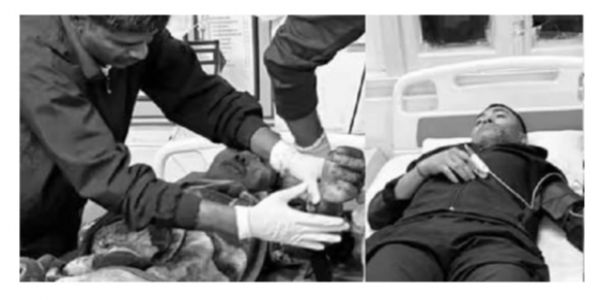 Grenade Attack on Assam Police Commando Camp in Tinsukia, Four Injured