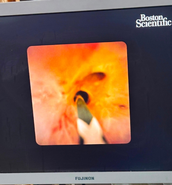 Swarup Rani Nehru Hospital (SRN) doctors treated a patient with a complex bile duct disease